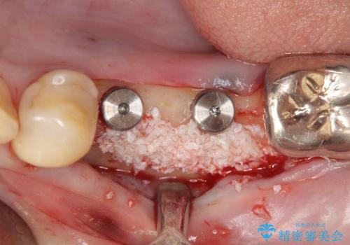 骨幅が薄い　奥歯のインプラント治療　GBR(骨増生)の治療中