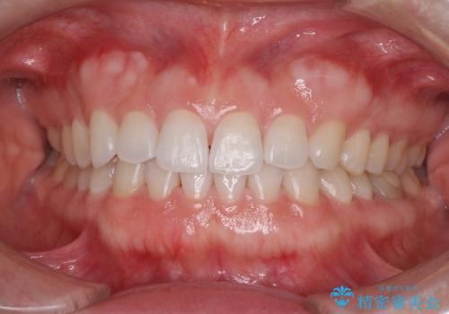 ASOアライナーによる、軽微な歯列不正の矯正治療の治療後