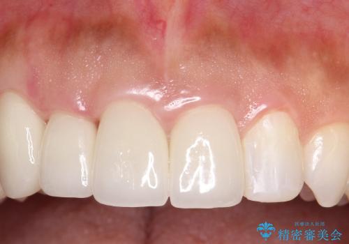 前歯のかぶせ物のやり変えによる歯肉の腫れの改善の治療後