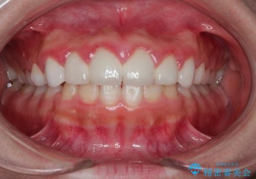 前歯の精密な被せ物による歯周組織の改善の治療前