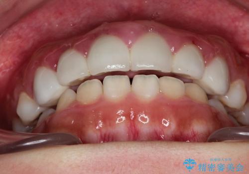 前歯の精密な被せ物による歯周組織の改善の治療前
