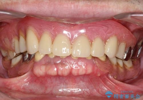 インプラントが困難な場合の入れ歯治療　コーヌスデンチャーの治療前