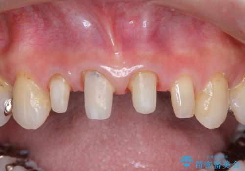 40代女性　矯正後の前歯の完成の治療中