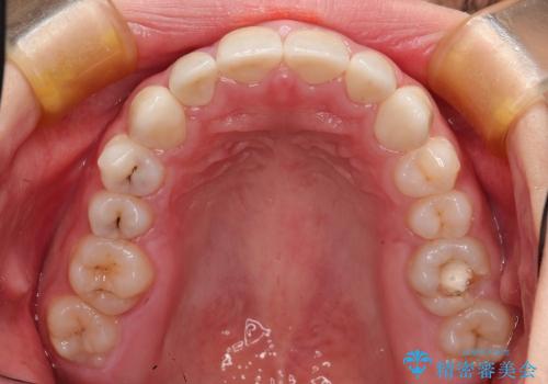前歯の精密な被せ物による歯周組織の改善の治療後
