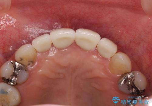 40代女性　矯正後の前歯の完成の治療後