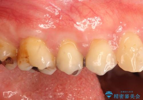 WSDによる知覚過敏を、歯茎の再生で治すの治療後