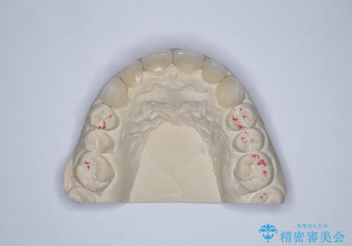 前歯の精密な被せ物による歯周組織の改善の治療中
