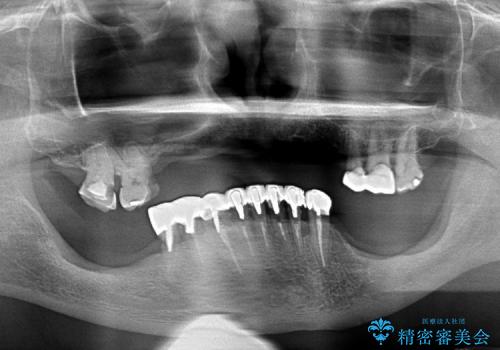 インプラントが困難な場合の入れ歯治療　コーヌスデンチャーの治療前
