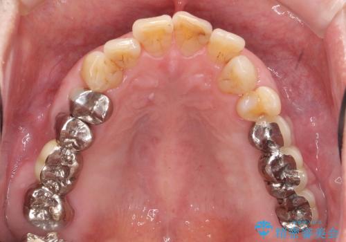 [歯が割れた] 咬み合わせが強い場合のインプラント治療の治療後