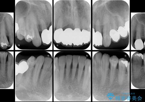歯槽骨の再生治療を用いた歯周病治療の治療後
