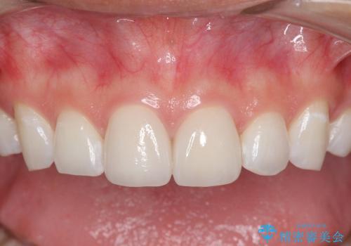 [審美治療] 歯の白斑の治療の治療後