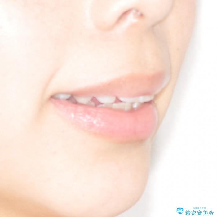 30代女性　前歯の裏側部分矯正の治療前（顔貌）