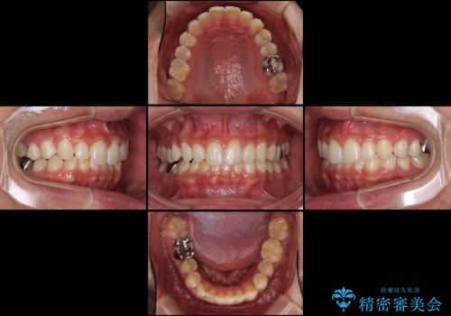 ASOアライナーによる、軽微な歯列不正の矯正治療　その2の治療後