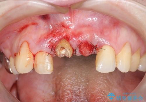 [エプーリスの切除] 前歯オールセラミック ブリッジ治療の治療中