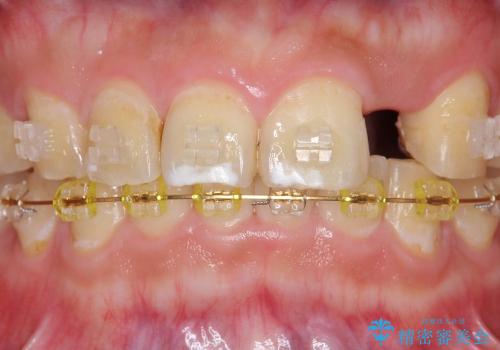 [前歯部インプラント] 前歯がないインプラントによる前歯部審美回復の治療前