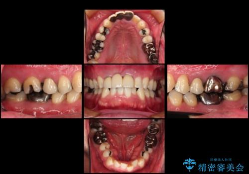 前歯の抜歯、歯茎を再生してブリッジで治すの治療前