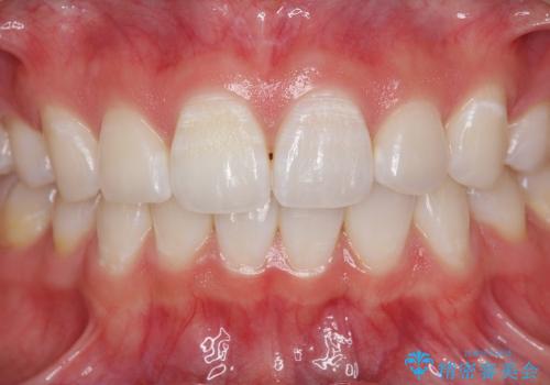 [審美治療] 歯の白斑の治療の治療前