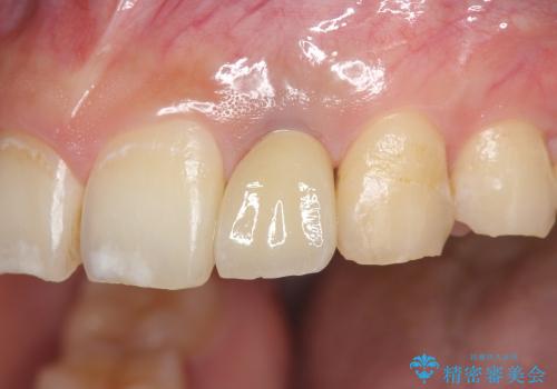 [前歯部インプラント] 前歯がないインプラントによる前歯部審美回復の治療後