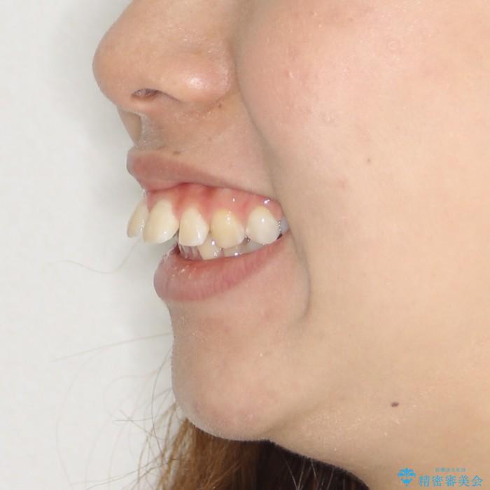 20代女性　ハーフリンガル　出っ歯の解消の治療前（顔貌）
