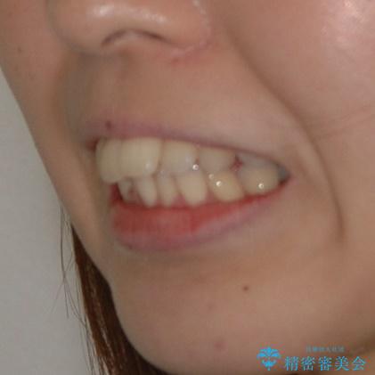 20代女性　ハーフリンガル　出っ歯の改善の治療前（顔貌）