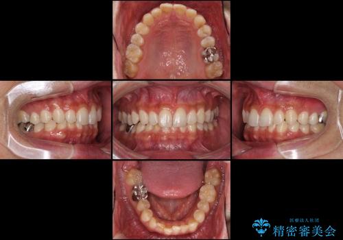 ASOアライナーによる、軽微な歯列不正の矯正治療　その2の治療前