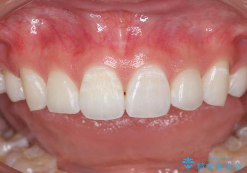 [審美治療] 歯の白斑の治療の治療前