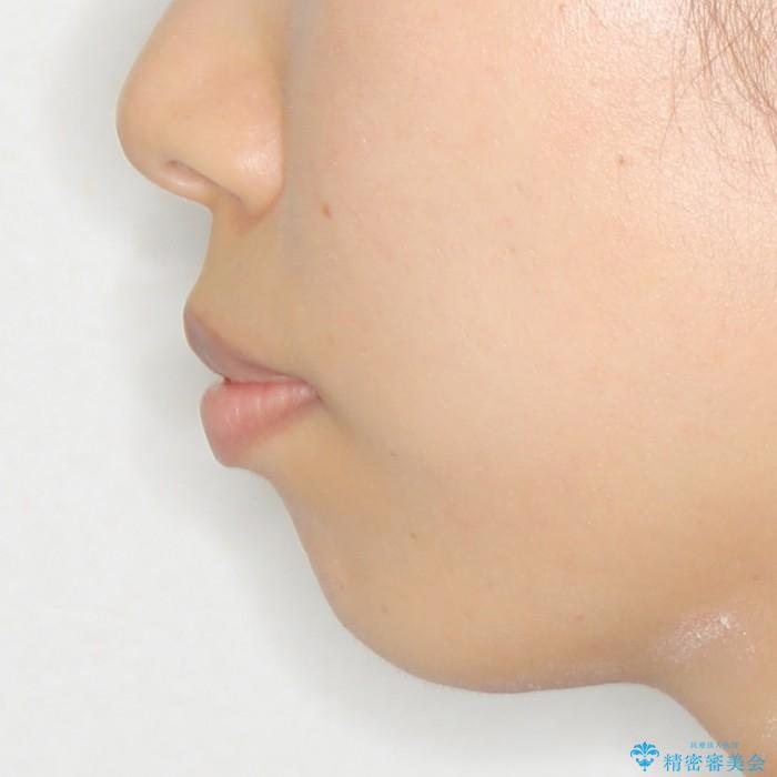 20代女性　ハーフリンガル　上下前突の改善の治療前（顔貌）