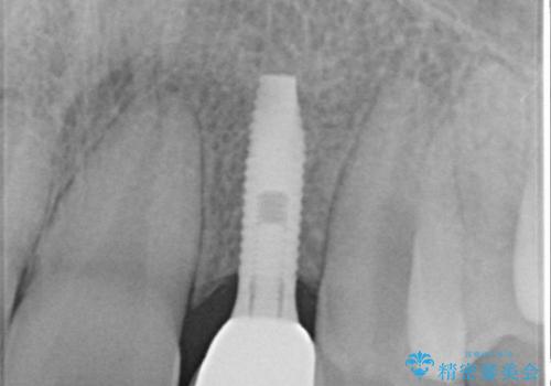 [前歯部インプラント] 前歯がないインプラントによる前歯部審美回復の治療後