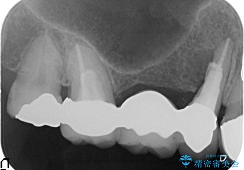 ブリッジの土台の歯が割れた　インプラントによる奥歯の補綴治療の治療前
