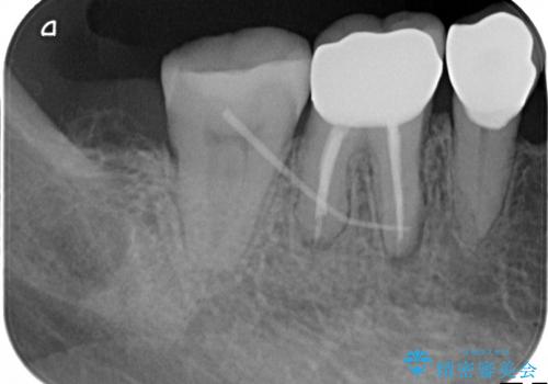 より安定した歯科治療を求めて　カスタムアバットメントと最上位オールセラミッククラウンの治療前