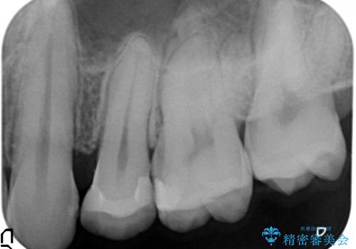 20代男性　セラミックインレーによる歯の形態修復の治療後