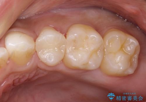 20代男性　セラミックインレーによる歯の形態修復の治療後