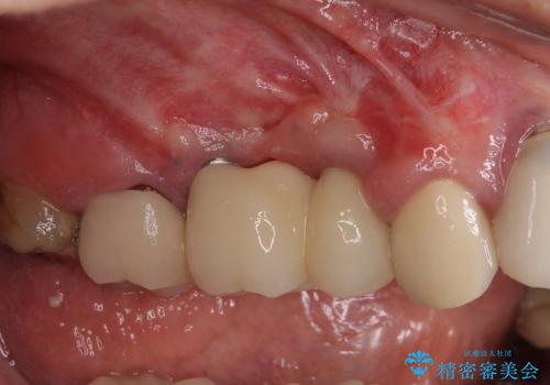 ブリッジの土台の歯が割れた　インプラントによる奥歯の補綴治療の治療後