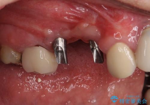 ブリッジの土台の歯が割れた　インプラントによる奥歯の補綴治療の治療後