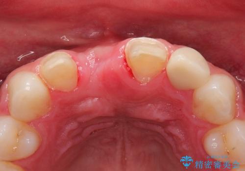 30代男性　前歯のへこみ　骨の移植で改善の治療後