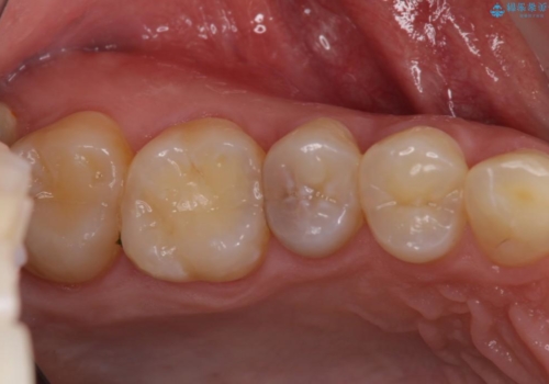 フロスが引っかかり始めたら治療のサイン　セラミックインレーによるむし歯治療の治療前