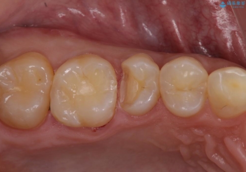 フロスが引っかかり始めたら治療のサイン　セラミックインレーによるむし歯治療の治療中