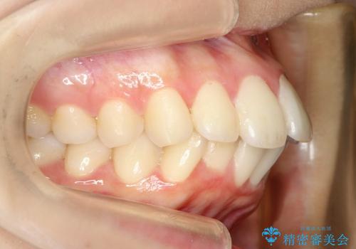 20代女性　ハーフリンガル　出っ歯の改善の治療前