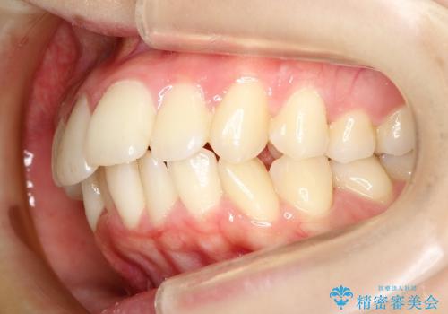 20代女性　ハーフリンガル　出っ歯の改善の治療前