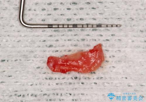 30代男性　前歯のへこみ　骨の移植で改善の治療中