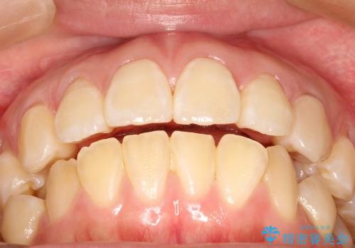 30代女性　前歯の裏側部分矯正の治療後