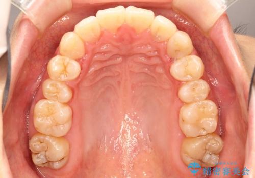 30代女性　前歯の裏側部分矯正の治療後