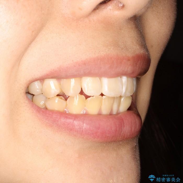 30代女性　前歯の裏側部分矯正の治療後（顔貌）