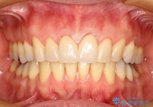 30代女性　矯正後の前歯の完成の治療後