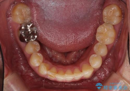 ASOアライナーによる、軽微な歯列不正の矯正治療　その2の治療後