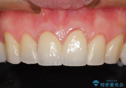 30代女性　矯正後の前歯の完成の治療後