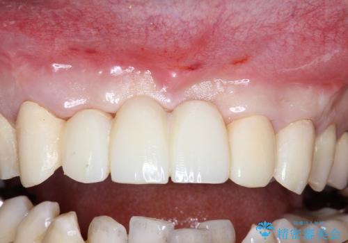 前歯の抜歯、歯茎を再生してブリッジで治すの治療中