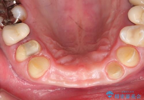 前歯の抜歯、歯茎を再生してブリッジで治すの治療後