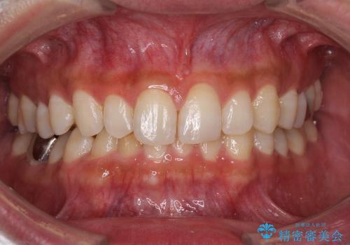 ASOアライナーによる、軽微な歯列不正の矯正治療　その2の治療前