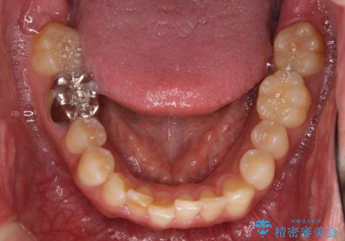 ASOアライナーによる、軽微な歯列不正の矯正治療　その2